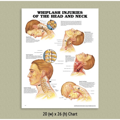 Anatomical Chart - Whiplash