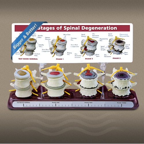 3 Stage Spine Degeneration Model