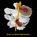 3 Stage Spine Degeneration Model